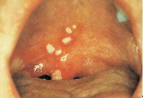 头部疱疹图片,症状、原因及预防措施解析  第3张